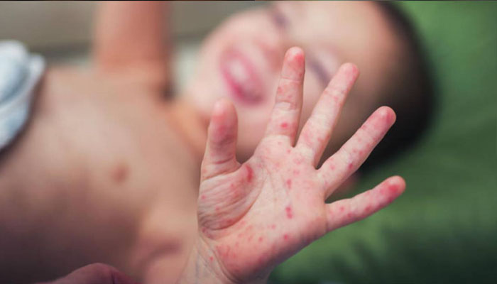 Death of children due to diphtheria and measles revealed in Punjab Death of children due to diphtheria and measles revealed in Punjab