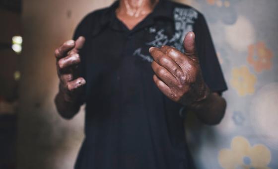 UN rights expert calls on Bangladesh to draft anti-discrimination leprosy laws