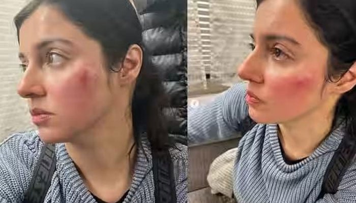 The Indian actress was injured while filming an action scene The Indian actress was injured while filming an action scene