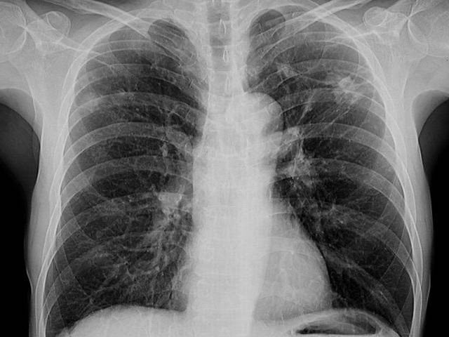 Cornell University experts have developed a new compound against TB which has been tested on mice.  Photo: File 