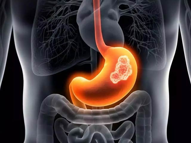 New stomach cancer therapy eradicates cancer in mice Scientists have successfully demonstrated a combination of nanoparticles and antibodies to eradicate gastric cancer in mice. Photo: File