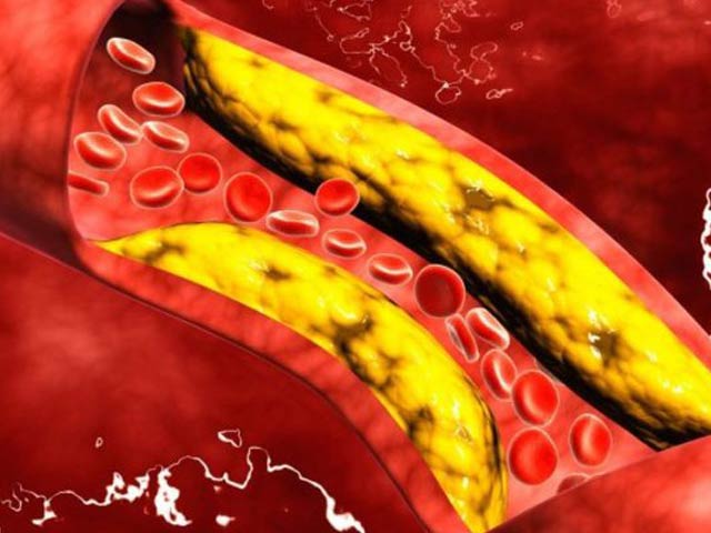 Pill to reduce cholesterol by 60%, successful in human trials