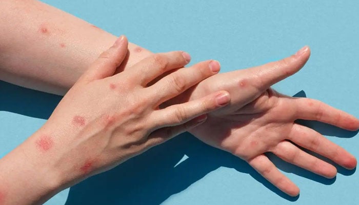 There is no confirmed case of monkeypox in Karachi, Sindh Health Department Spokesperson There is no confirmed case of monkeypox in Karachi, Sindh Health Department Spokesperson