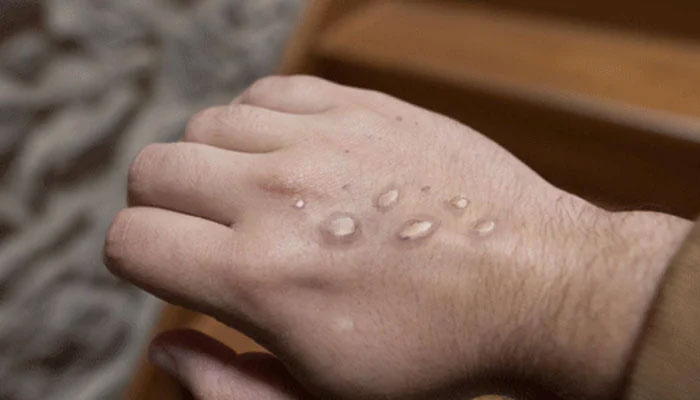 Both monkeypox patients in Pakistan have recovered —File photo