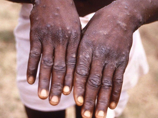 2 cases of monkeypox confirmed in Pakistan