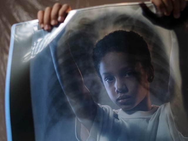 International experts have developed a TB detection algorithm that can accurately identify the disease in children.  Photo: File 