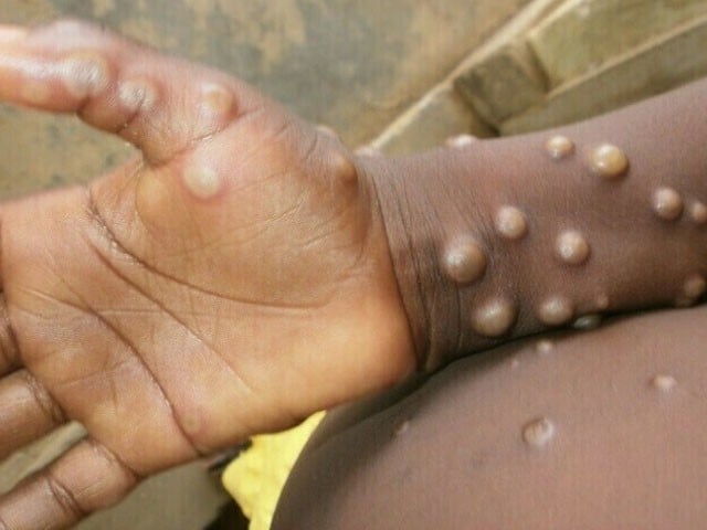 Karachi: Fear of spread of monkey pox, isolation ward established in Jinnah and Civil Hospital Currently no cases have been reported, however staff are being trained, MS Civil Hospital (Photo: File)