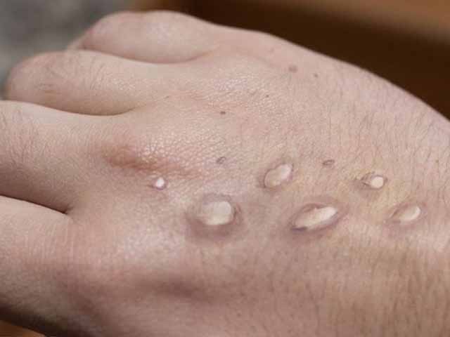 Pakistan's decision to approach World Health Organization for monkeypox vaccine