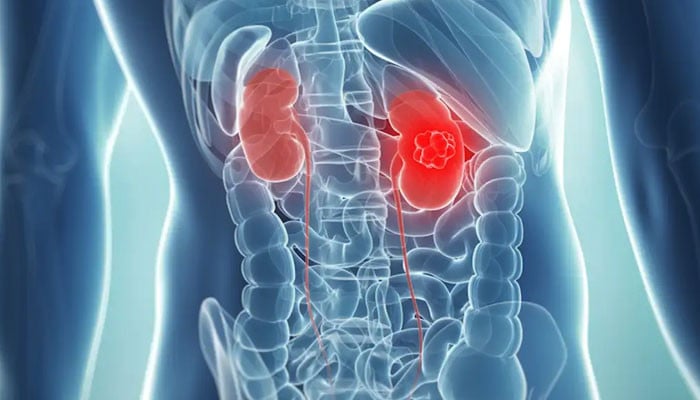 5 Bad Habits That Cause Kidney Failure