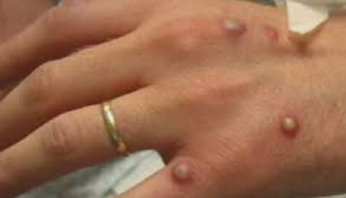 The first case of monkeypox was reported in Lahore File photo