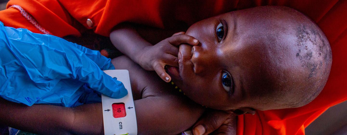 One-year-old Ahmed Mohammed undergoes a malnutrition check at an outpatient therapeutic feeding programme site supported by humanitarian partners in Jubaland state, Somalia, a country where an estimated 1.8 million children under age five will be acutely… One-year-old Ahmed Mohammed undergoes a malnutrition check at an outpatient therapeutic feeding programme site supported by humanitarian partners in Jubaland state, Somalia, a country where an estimated 1.8 million children under age five will be acutely…