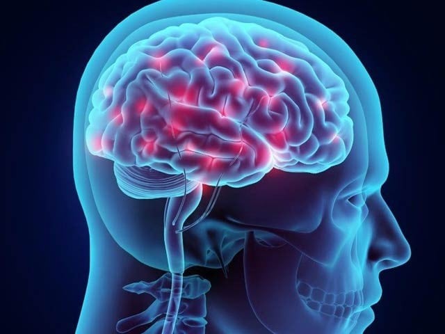 Effective treatment of brain hemorrhage is possible through research in many countries including Pakistan Research conducted on thousands of people in many countries has shown that bundle therapy called Interact 3 can save the lives of brain hemorrhage patients. Photo: File