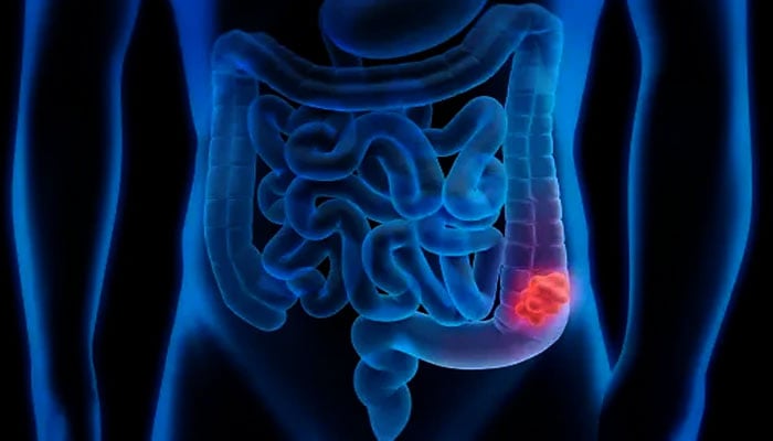 What are the two foods that cause colon cancer in young people? File photo
