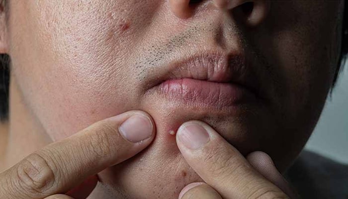 Foods to Get Rid of Pimples and Brighten Skin in Summer File photo