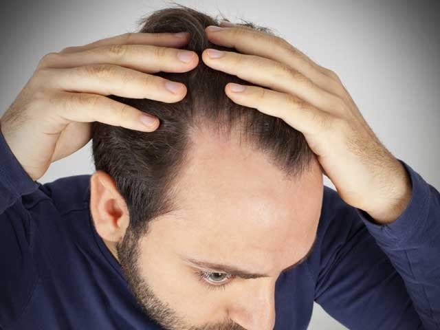 Experts have discovered a key molecular mechanism that may allow baldness to regrow hair.  Photo: File 