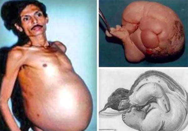 A pregnant man in India has surprised medical experts