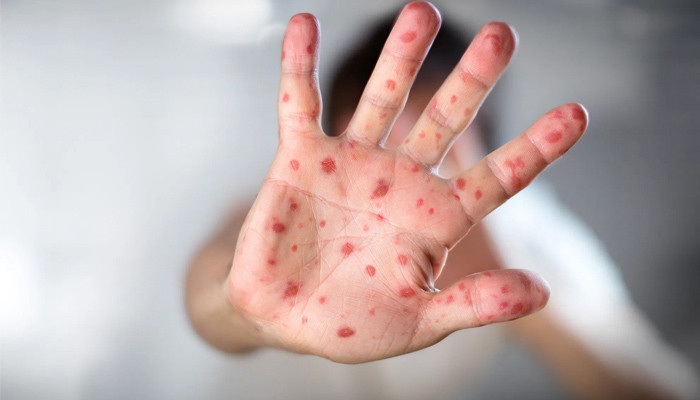 More than 2 thousand cases of measles reported in April