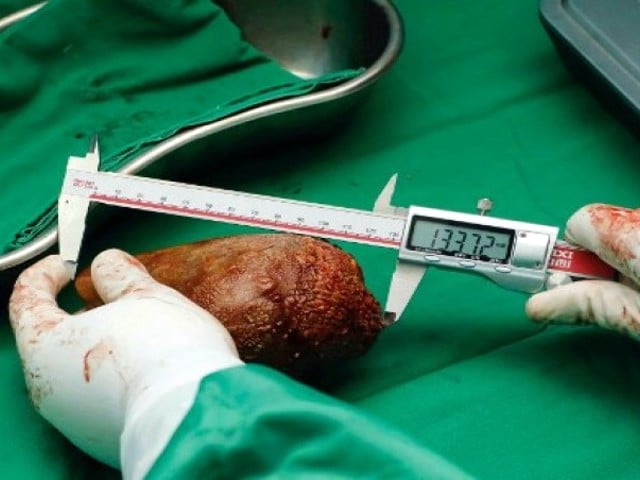 Sri Lanka: Largest stone ever removed from patient's kidney