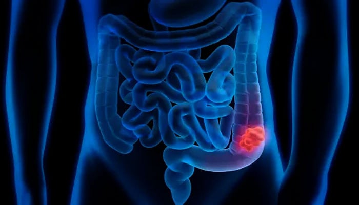 What are the two foods that cause colon cancer in young people?