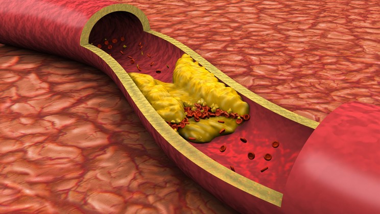 What to eat for breakfast to lower cholesterol?