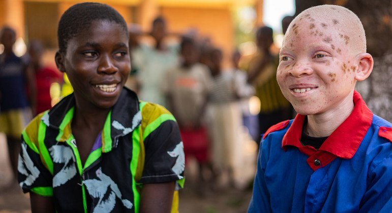 ‘Inclusion is strength’ stresses UN, marking Albinism Awareness Day