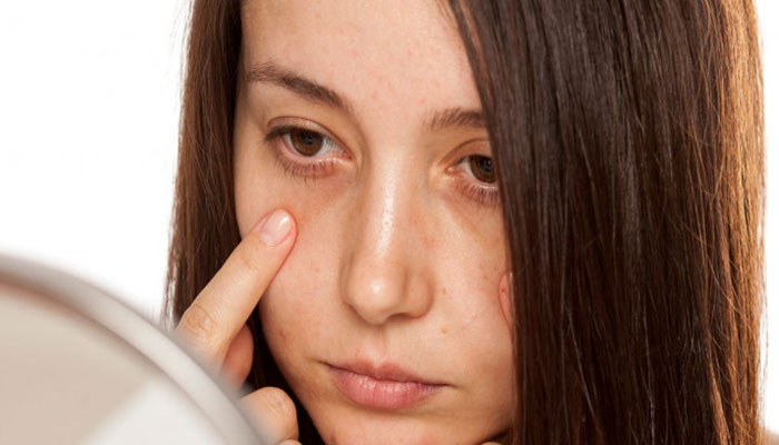 5 Foods That Eliminate Dark Circles File photo
