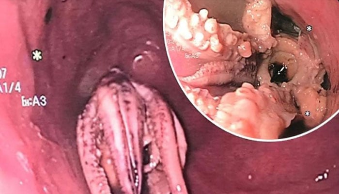Doctors in Singapore removed an octopus stuck in a patient's esophagus Courtesy: Oddity Central.