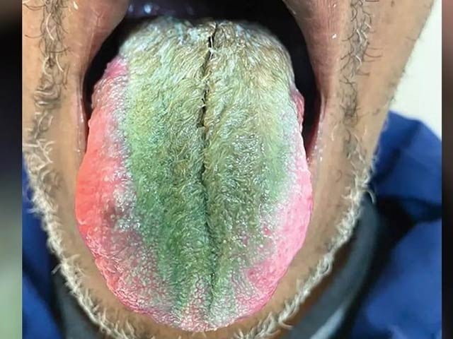 Smoking and the use of antibiotics cause green hairs to grow on the tongue A long-time smoker had a green tongue and hair growth after taking antibiotics. Photo: Courtesy of the New England Journal of Medicine