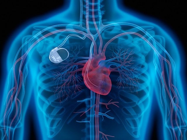 A new pacemaker will improve the lives of people with heart failure