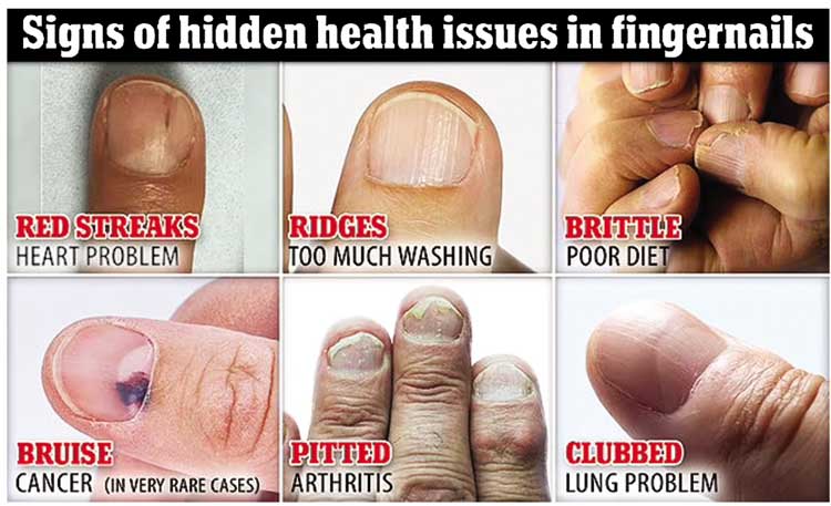 Human nails... indicators of diseases