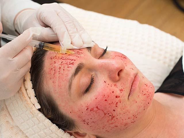 Increased HIV and other infections from vampire facials