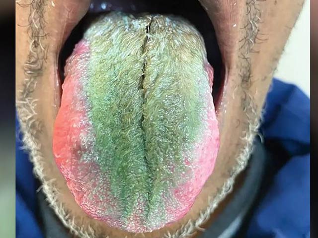 Smoking and the use of antibiotics cause green hairs to grow on the tongue