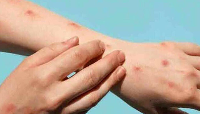 11 cases of chicken pox reported in Peshawar