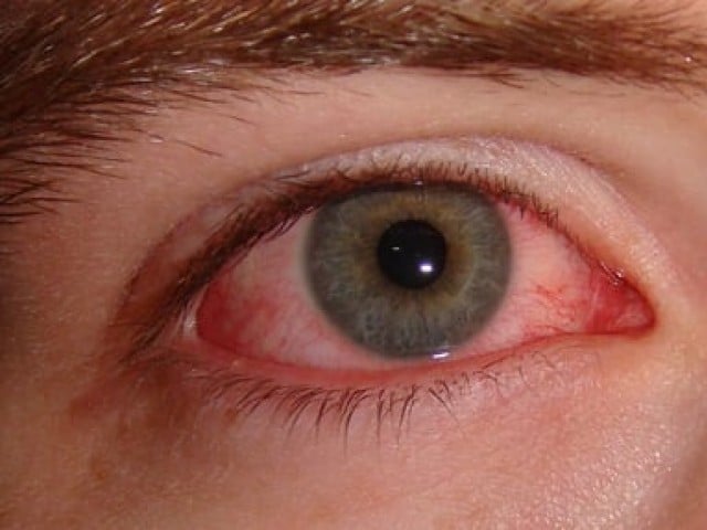 Conjunctivitis is not caused by looking into the affected person's eyes, experts say Artificial shortage of eye drops after conjunctivitis epidemic in Karachi