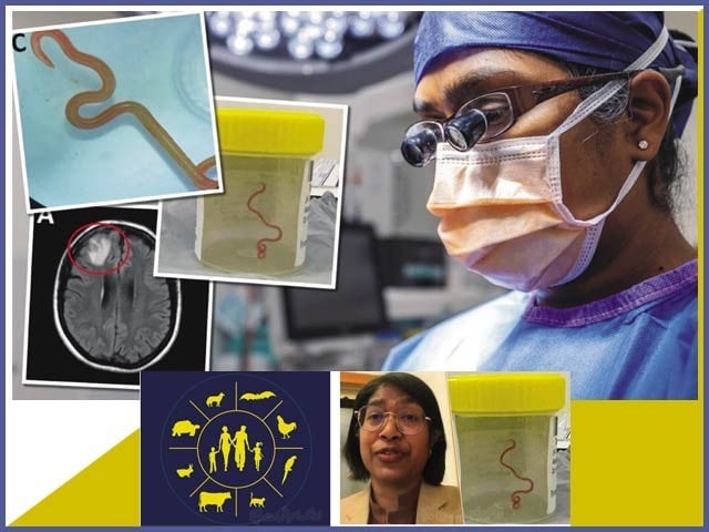 A living worm emerged in the human brain A dramatic story of an amazing incident in the history of medicine. Photo: File