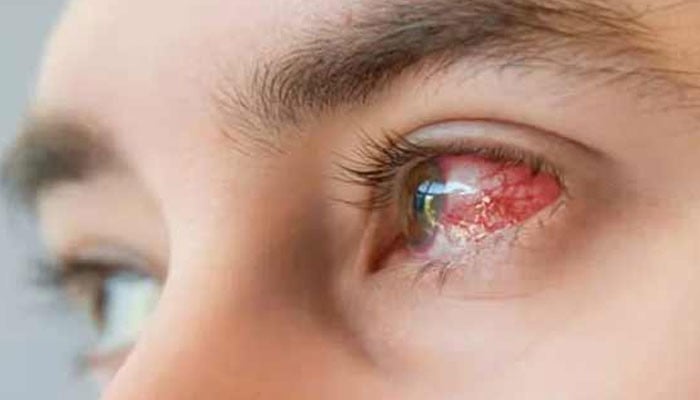 354 cases of conjunctivitis have been reported so far