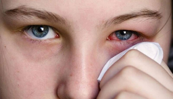 Cases of conjunctivitis started increasing in Karachi