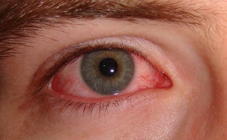 Conjunctivitis is not caused by looking into the affected person's eyes, experts say