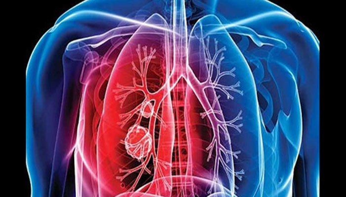 Increase in the number of TB patients in Pakistan