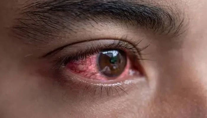 Cases of conjunctivitis started decreasing in Punjab —File photo