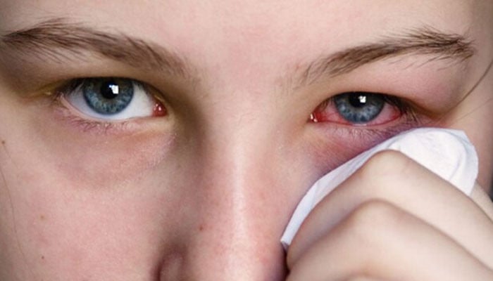 2 thousand 167 new cases of conjunctivitis reported