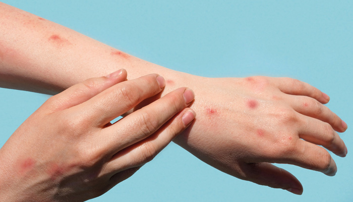 World Health Organization's assurance to give monkeypox medicine to Pakistan --File photo