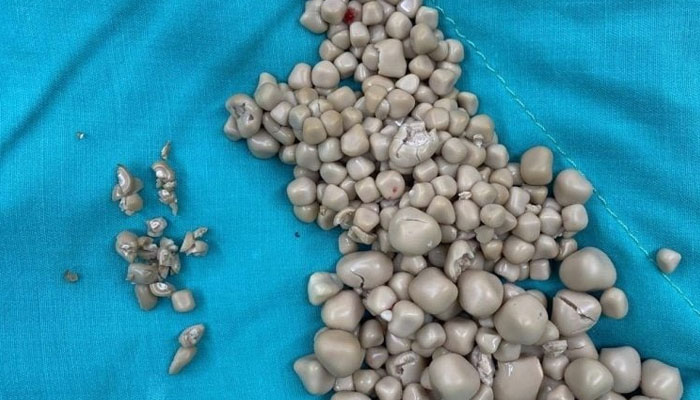 More than 300 stones were removed from the kidneys of a Taiwanese woman More than 300 stones were removed from the kidneys of a Taiwanese woman