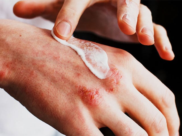 Excessive use of medicines for skin diseases is harmful for bones