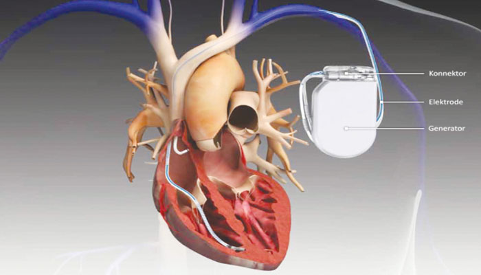 Introduction of a pulse-charged pacemaker