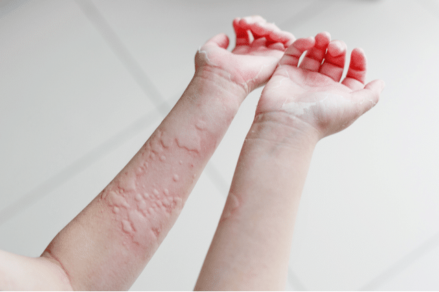 Skin allergy and its symptoms and causes