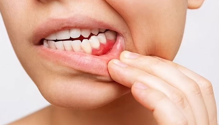 Bleeding gums may cause lung disease, research