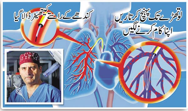 What is 'pulmonary embolism'?  - Express Urdu