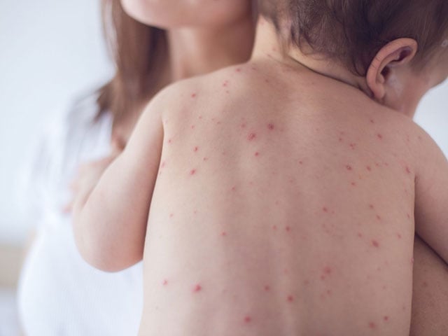 Measles and diphtheria outbreaks in Karachi