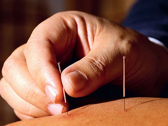 Acupuncture May Reduce Stroke Risks, Research